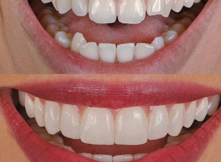 Is Gum Contouring Right for You?